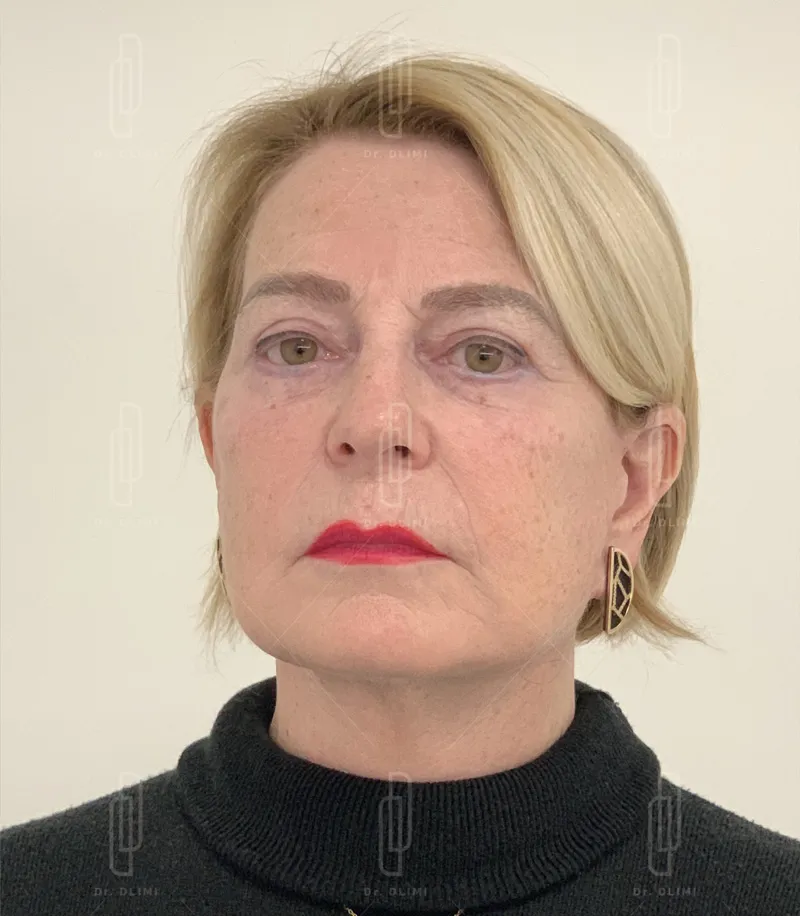 après intervention lifting du visage