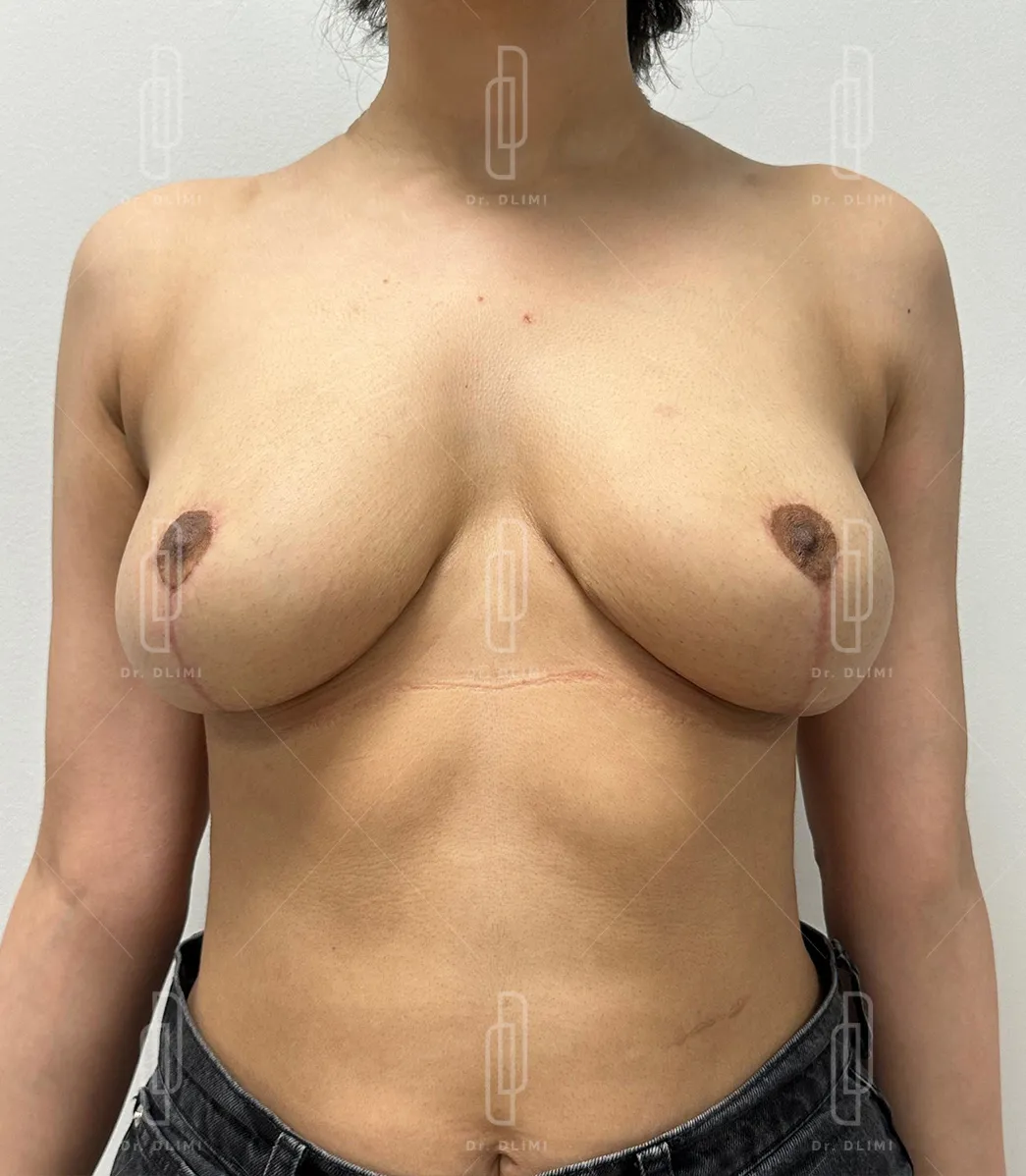 patiente après l'intervention de réduction mammaire