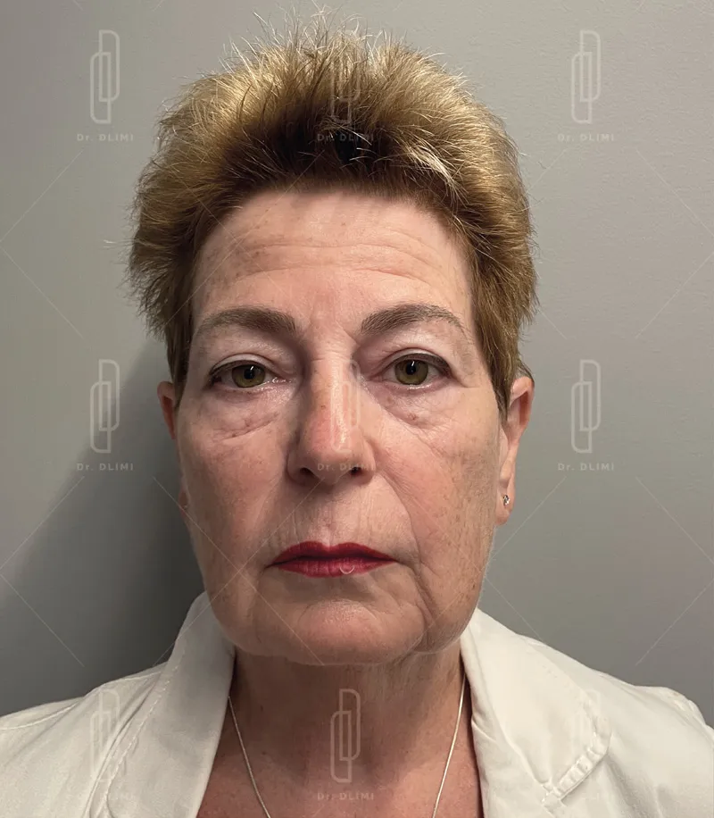 avant intervention lifting du visage