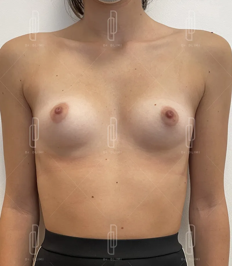 photo avant augmentation mammaire composite