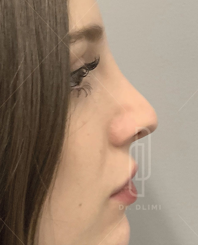 rhinoplastie après intervention