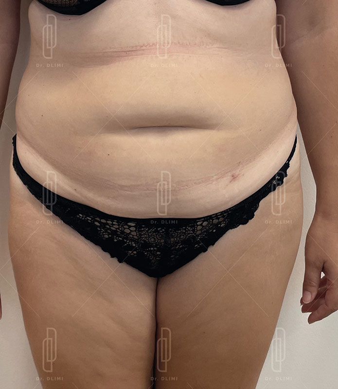 abdominoplastie avant intervention