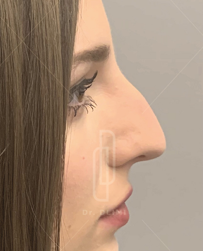 rhinoplastie avant intervention