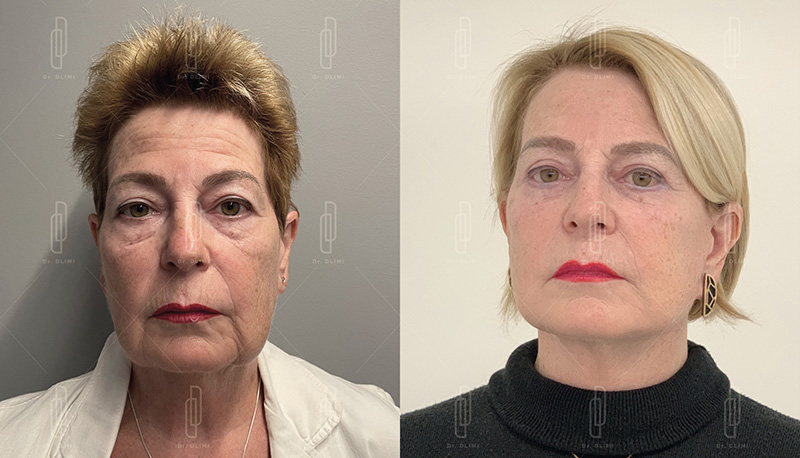 Lifting du visage à Lyon Dr Dlimi chirurgie esthétique