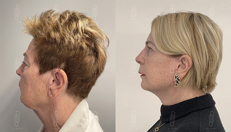 Lifting du visage à Lyon Dr Dlimi chirurgie esthétique