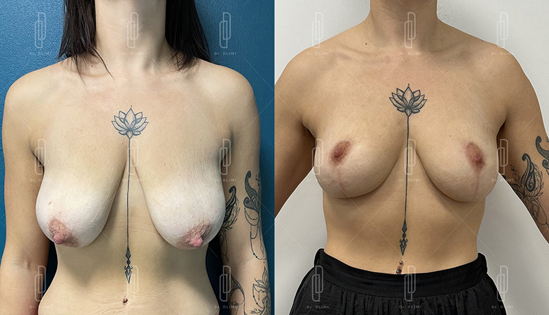 lifting mammaire à Lyon Dr Dlimi chirurgie esthétique