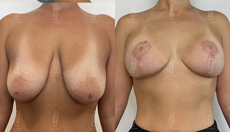 lifting mammaire à Lyon Dr Dlimi chirurgie esthétique