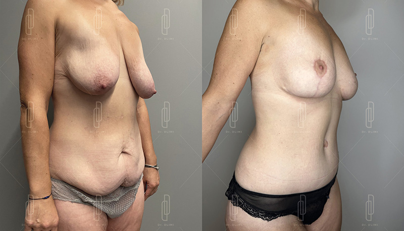 mommy makeover à Lyon Dr Dlimi chirurgie esthétique