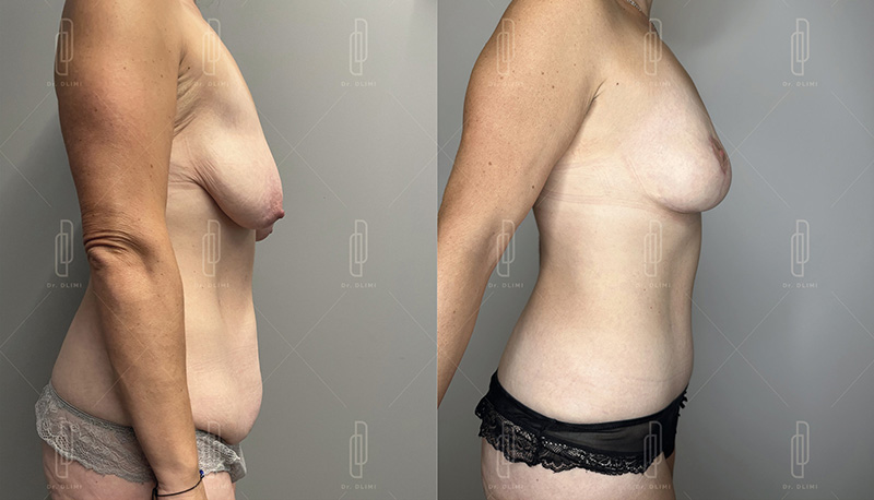 mommy makeover à Lyon Dr Dlimi chirurgie esthétique