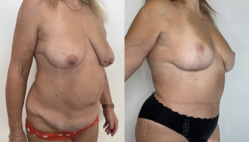 mommy makeover à Lyon Dr Dlimi chirurgie esthétique