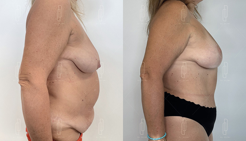 mommy makeover à Lyon Dr Dlimi chirurgie esthétique