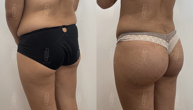 Prothèses de fesses à Lyon Dr Dlimi chirurgien esthétique