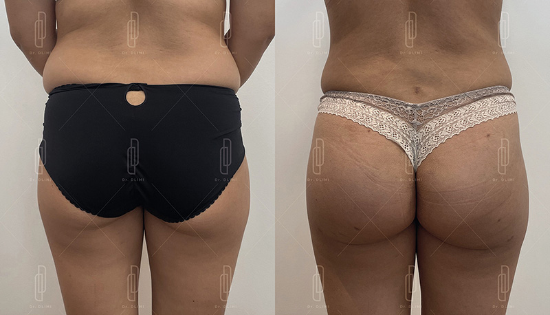 Prothèses de fesses à Lyon Dr Dlimi chirurgien esthétique