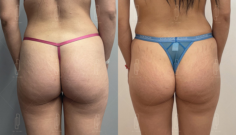 Prothèses de fesses à Lyon Dr Dlimi chirurgien esthétique