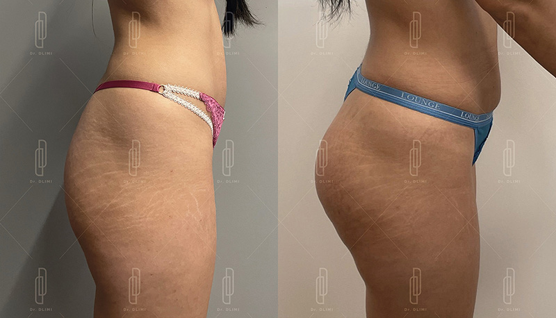 Prothèses de fesses à Lyon Dr Dlimi chirurgien esthétique