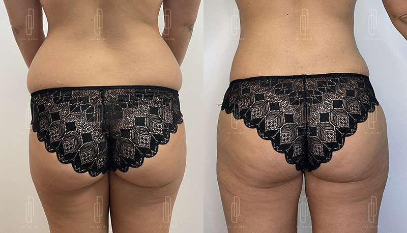 Prothèses de fesses à Lyon Dr Dlimi chirurgien esthétique