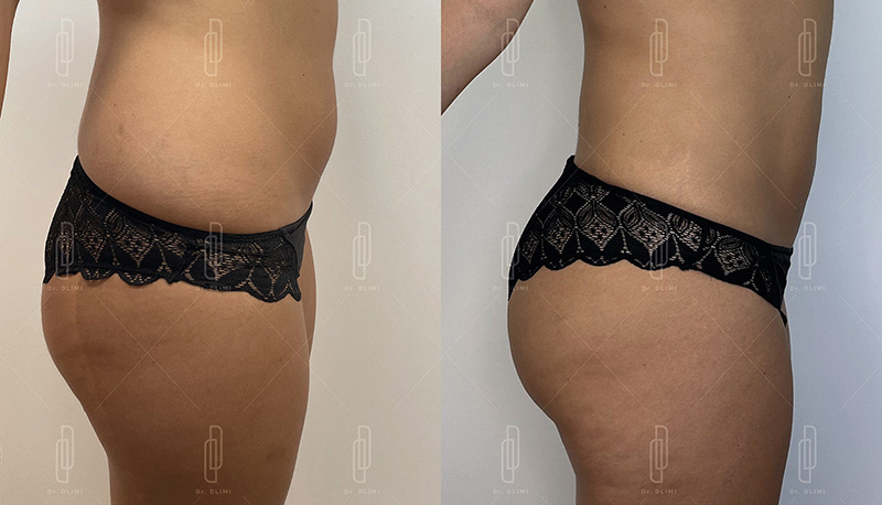 Prothèses de fesses à Lyon Dr Dlimi chirurgien esthétique