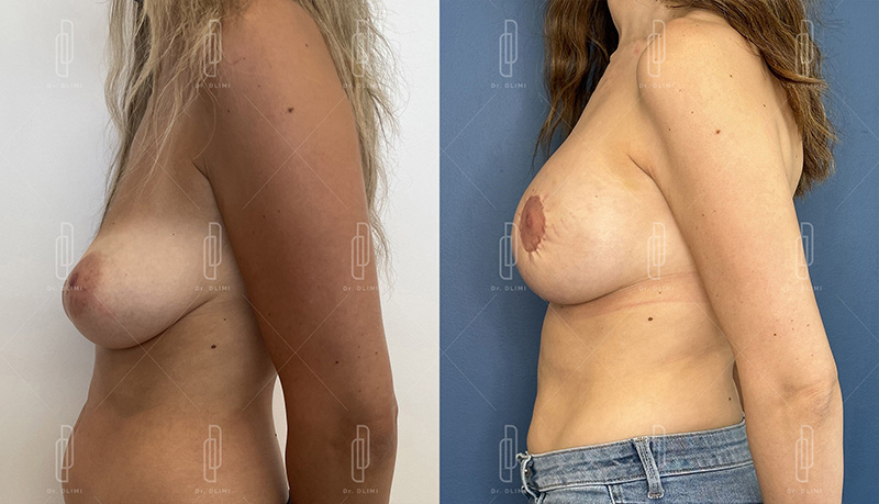 reconstruction mammaire à Lyon Dr Dlimi chirurgie esthétique