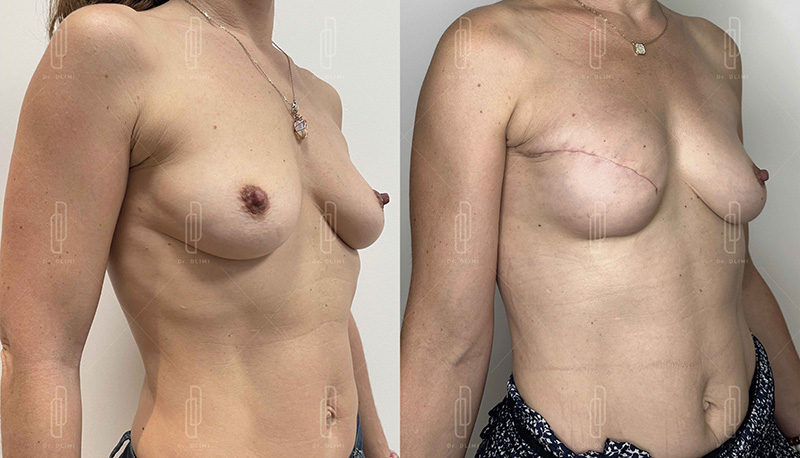 reconstruction mammaire à Lyon Dr Dlimi chirurgie esthétique