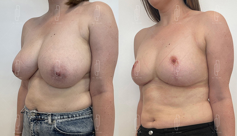 réduction mammaire à Lyon Dr Dlimi chirurgie esthétique