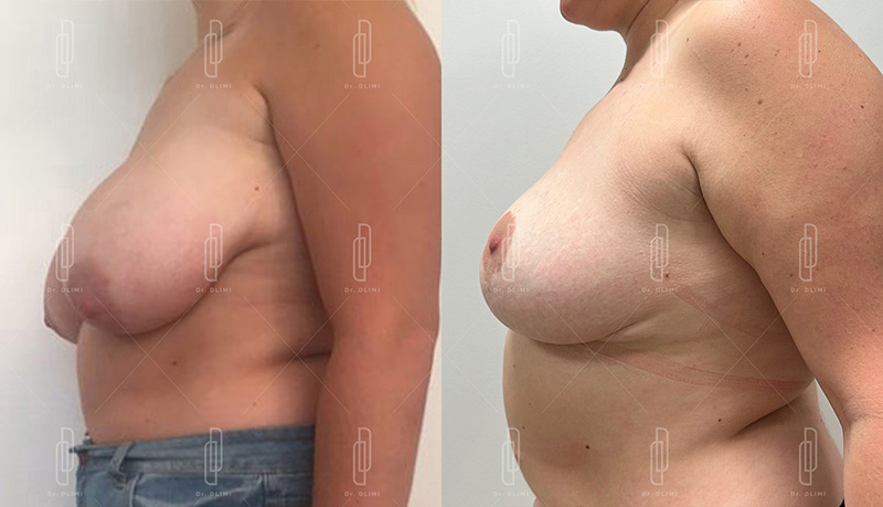 réduction mammaire à Lyon Dr Dlimi chirurgie esthétique
